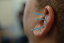 Mann von hinten mit Akupunkturnadeln im Ohr